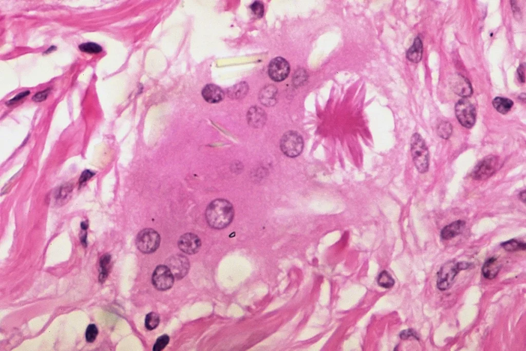 the-silent-crisis-how-sarcoidosis-highlights-the-urgent-need-for-biomedical-equity