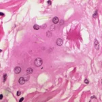 the-silent-crisis-how-sarcoidosis-highlights-the-urgent-need-for-biomedical-equity